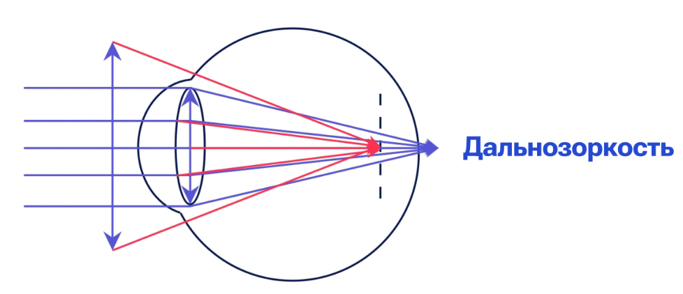 Нарушения фокусировки зрения