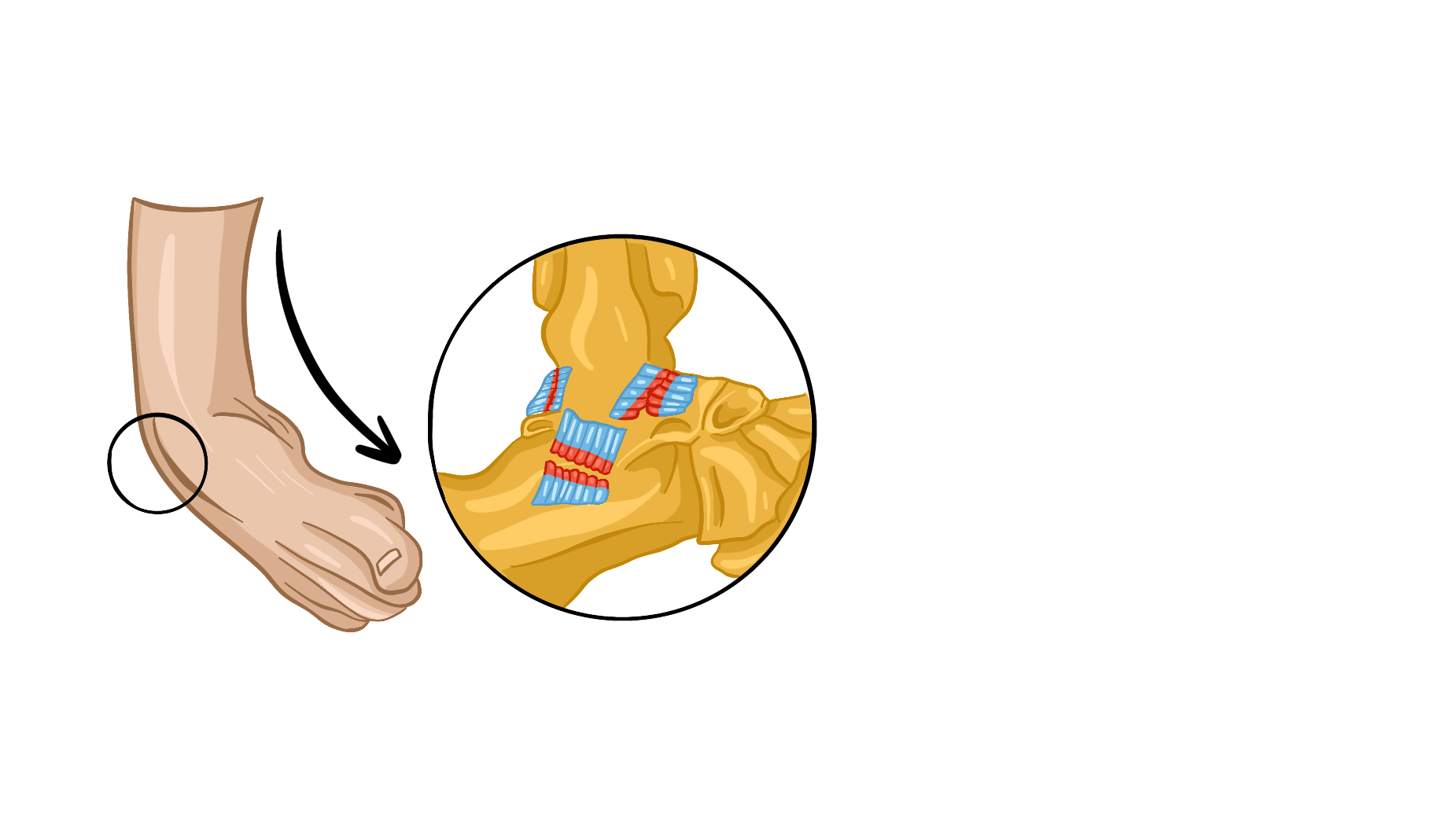 Растяжение